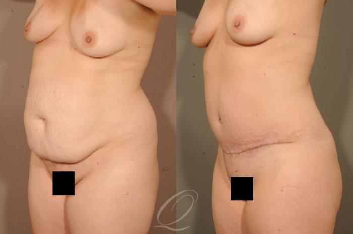 Tummy Tuck Case 279 Before & After View #2 | Serving Rochester, Syracuse & Buffalo, NY | Quatela Center for Plastic Surgery