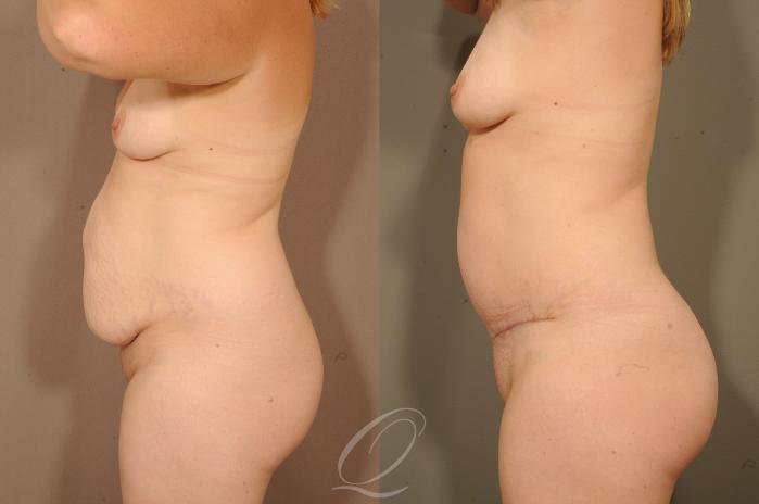 Tummy Tuck Case 279 Before & After View #3 | Serving Rochester, Syracuse & Buffalo, NY | Quatela Center for Plastic Surgery