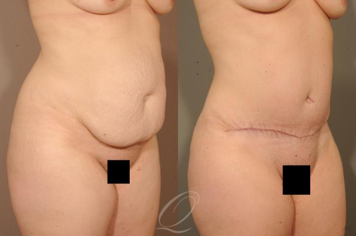 Tummy Tuck Case 279 Before & After View #4 | Serving Rochester, Syracuse & Buffalo, NY | Quatela Center for Plastic Surgery