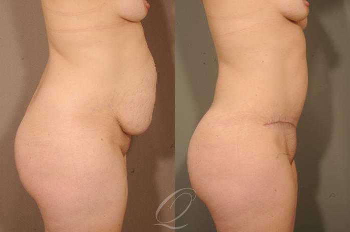 Tummy Tuck Case 279 Before & After View #5 | Serving Rochester, Syracuse & Buffalo, NY | Quatela Center for Plastic Surgery