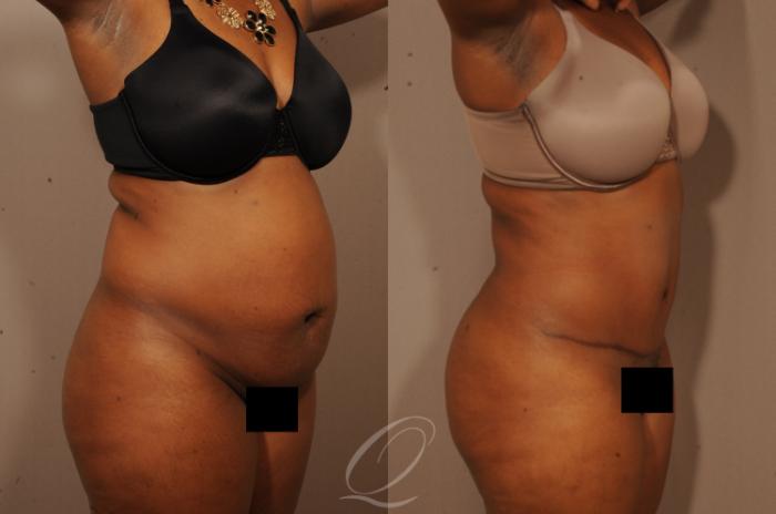 Tummy Tuck Case 286 Before & After View #2 | Serving Rochester, Syracuse & Buffalo, NY | Quatela Center for Plastic Surgery