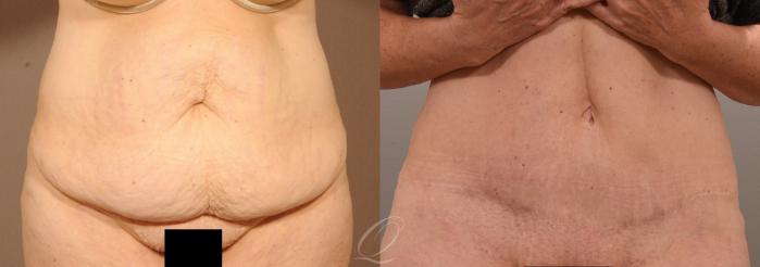 Tummy Tuck Case 287 Before & After View #1 | Serving Rochester, Syracuse & Buffalo, NY | Quatela Center for Plastic Surgery