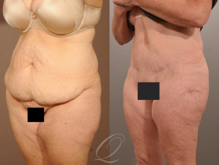 Tummy Tuck Case 287 Before & After View #2 | Serving Rochester, Syracuse & Buffalo, NY | Quatela Center for Plastic Surgery