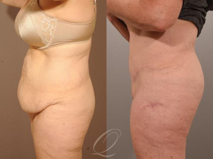 Tummy Tuck Case 287 Before & After View #3 | Serving Rochester, Syracuse & Buffalo, NY | Quatela Center for Plastic Surgery