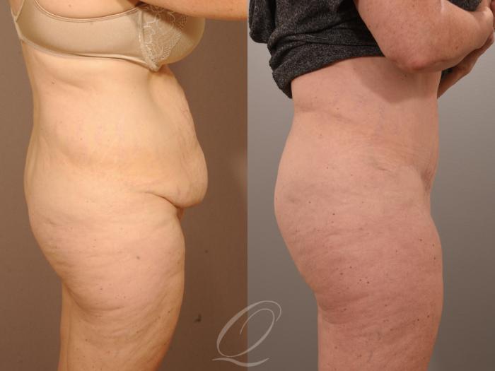 Tummy Tuck Case 287 Before & After View #5 | Serving Rochester, Syracuse & Buffalo, NY | Quatela Center for Plastic Surgery