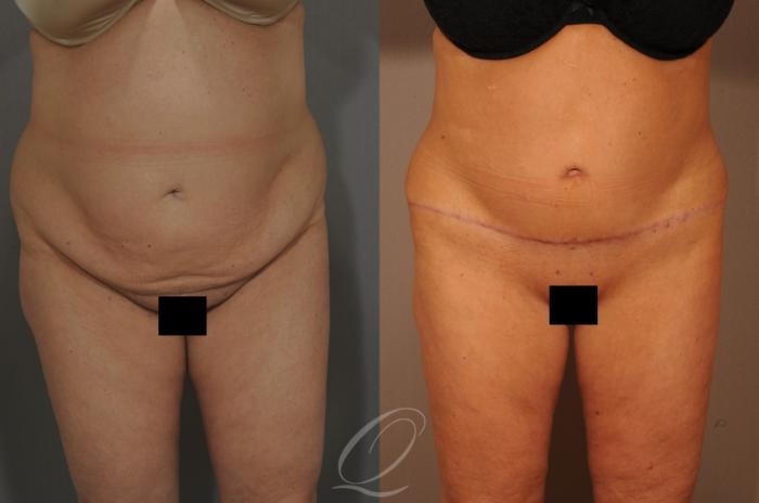 Tummy Tuck Case 288 Before & After View #1 | Serving Rochester, Syracuse & Buffalo, NY | Quatela Center for Plastic Surgery