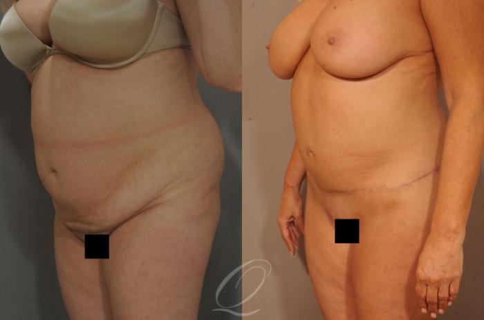Tummy Tuck Case 288 Before & After View #10 | Serving Rochester, Syracuse & Buffalo, NY | Quatela Center for Plastic Surgery