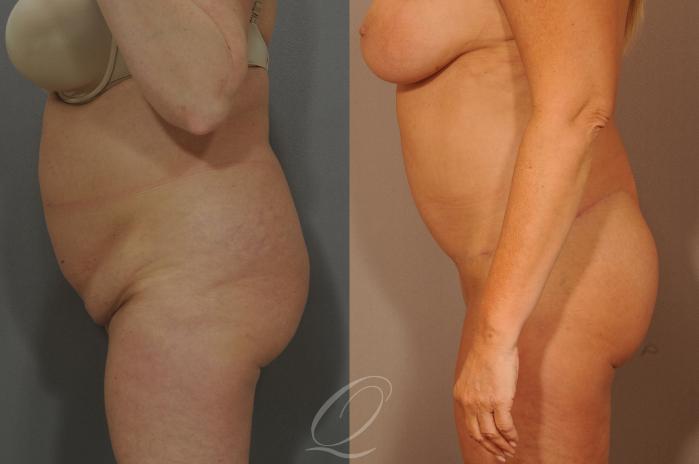 Tummy Tuck Case 288 Before & After View #11 | Serving Rochester, Syracuse & Buffalo, NY | Quatela Center for Plastic Surgery