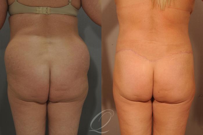 Tummy Tuck Case 288 Before & After View #12 | Serving Rochester, Syracuse & Buffalo, NY | Quatela Center for Plastic Surgery