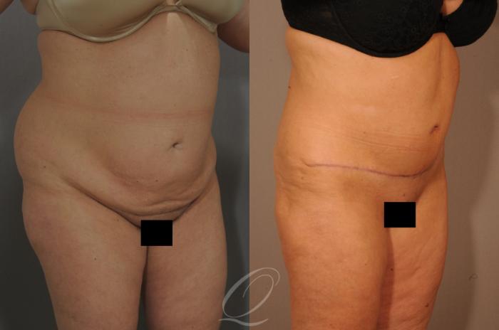 Tummy Tuck Case 288 Before & After View #2 | Serving Rochester, Syracuse & Buffalo, NY | Quatela Center for Plastic Surgery
