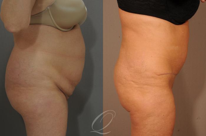 Tummy Tuck Case 288 Before & After View #3 | Serving Rochester, Syracuse & Buffalo, NY | Quatela Center for Plastic Surgery