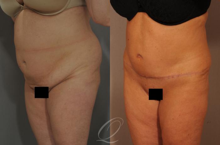 Tummy Tuck Case 288 Before & After View #4 | Serving Rochester, Syracuse & Buffalo, NY | Quatela Center for Plastic Surgery