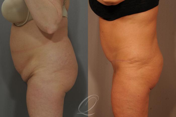 Tummy Tuck Case 288 Before & After View #5 | Serving Rochester, Syracuse & Buffalo, NY | Quatela Center for Plastic Surgery