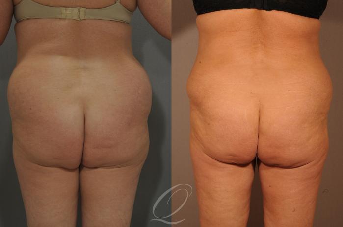 Tummy Tuck Case 288 Before & After View #6 | Serving Rochester, Syracuse & Buffalo, NY | Quatela Center for Plastic Surgery