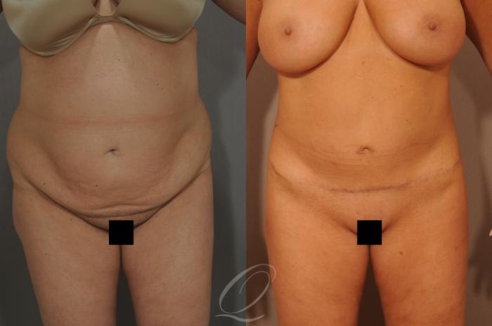 Tummy Tuck Case 288 Before & After View #7 | Serving Rochester, Syracuse & Buffalo, NY | Quatela Center for Plastic Surgery