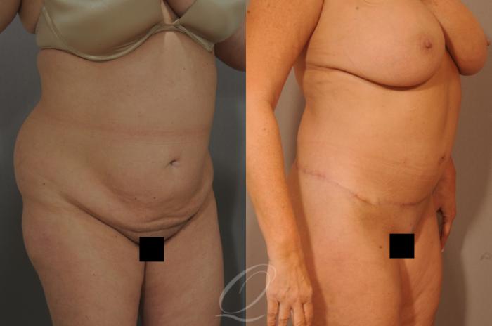 Tummy Tuck Case 288 Before & After View #8 | Serving Rochester, Syracuse & Buffalo, NY | Quatela Center for Plastic Surgery