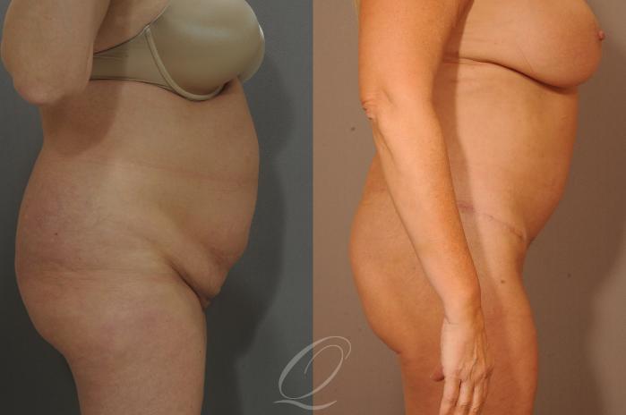 Tummy Tuck Case 288 Before & After View #9 | Serving Rochester, Syracuse & Buffalo, NY | Quatela Center for Plastic Surgery