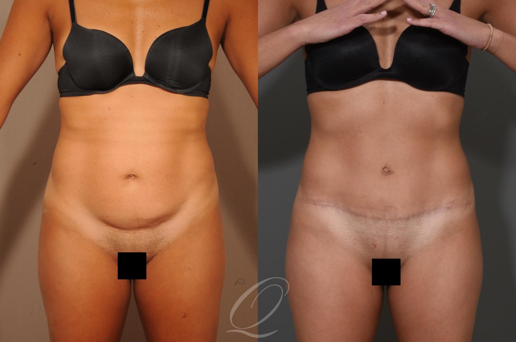 Tummy Tuck Case 331 Before & After View #1 | Serving Rochester, Syracuse & Buffalo, NY | Quatela Center for Plastic Surgery