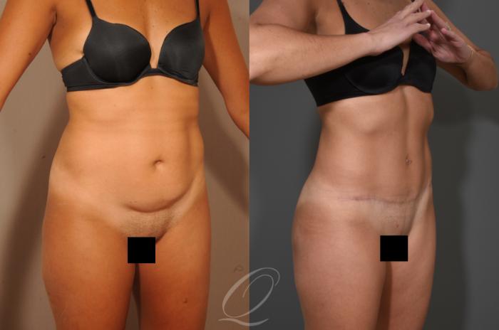 Tummy Tuck Case 331 Before & After View #2 | Serving Rochester, Syracuse & Buffalo, NY | Quatela Center for Plastic Surgery