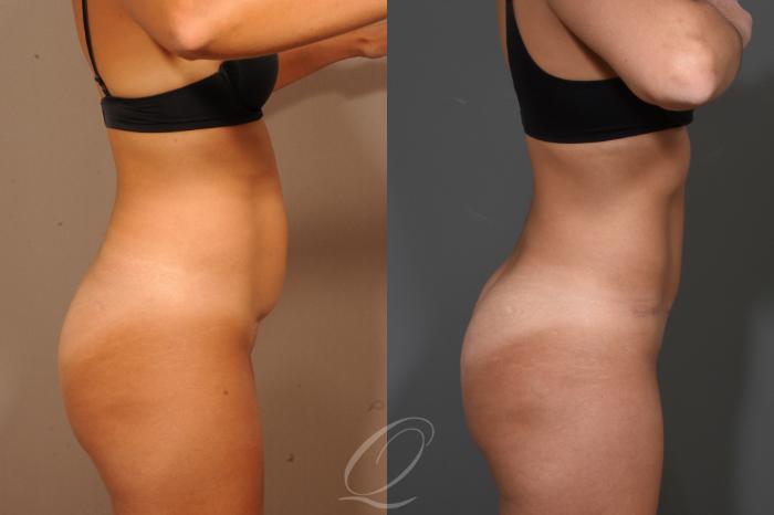 Tummy Tuck Case 331 Before & After View #3 | Serving Rochester, Syracuse & Buffalo, NY | Quatela Center for Plastic Surgery