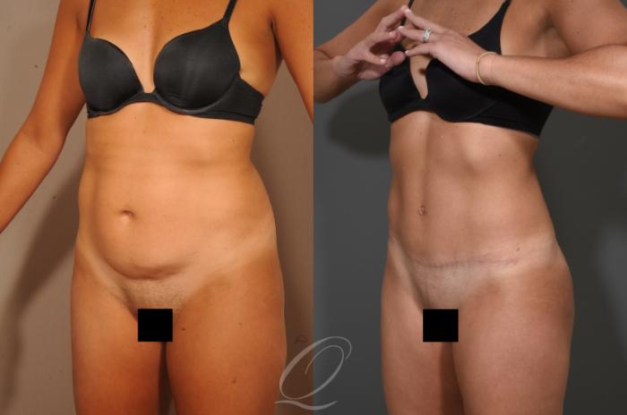 Tummy Tuck Case 331 Before & After View #4 | Serving Rochester, Syracuse & Buffalo, NY | Quatela Center for Plastic Surgery