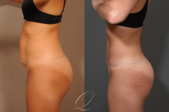 Tummy Tuck Case 331 Before & After View #5 | Serving Rochester, Syracuse & Buffalo, NY | Quatela Center for Plastic Surgery