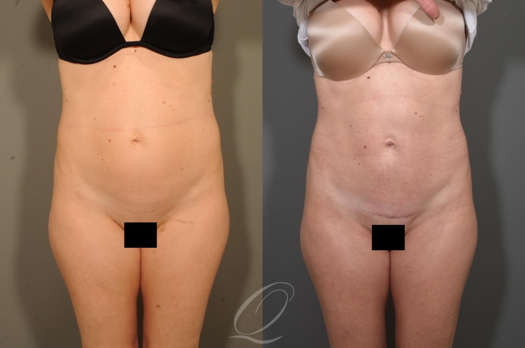 Tummy Tuck Case 340 Before & After View #1 | Serving Rochester, Syracuse & Buffalo, NY | Quatela Center for Plastic Surgery