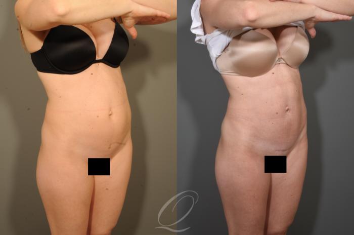 Tummy Tuck Case 340 Before & After View #2 | Serving Rochester, Syracuse & Buffalo, NY | Quatela Center for Plastic Surgery