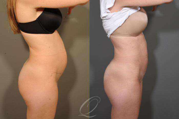 Tummy Tuck Case 340 Before & After View #3 | Serving Rochester, Syracuse & Buffalo, NY | Quatela Center for Plastic Surgery