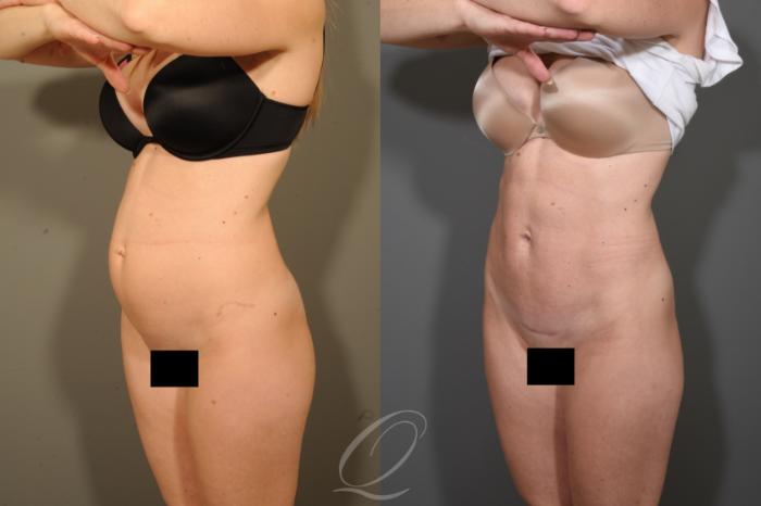 Tummy Tuck Case 340 Before & After View #4 | Serving Rochester, Syracuse & Buffalo, NY | Quatela Center for Plastic Surgery
