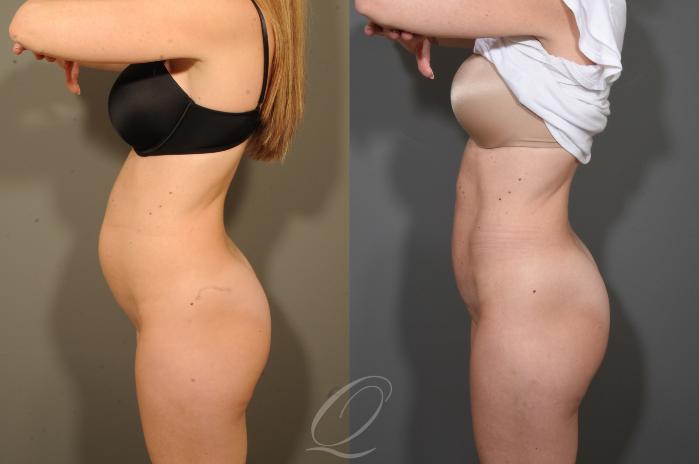 Tummy Tuck Case 340 Before & After View #5 | Serving Rochester, Syracuse & Buffalo, NY | Quatela Center for Plastic Surgery