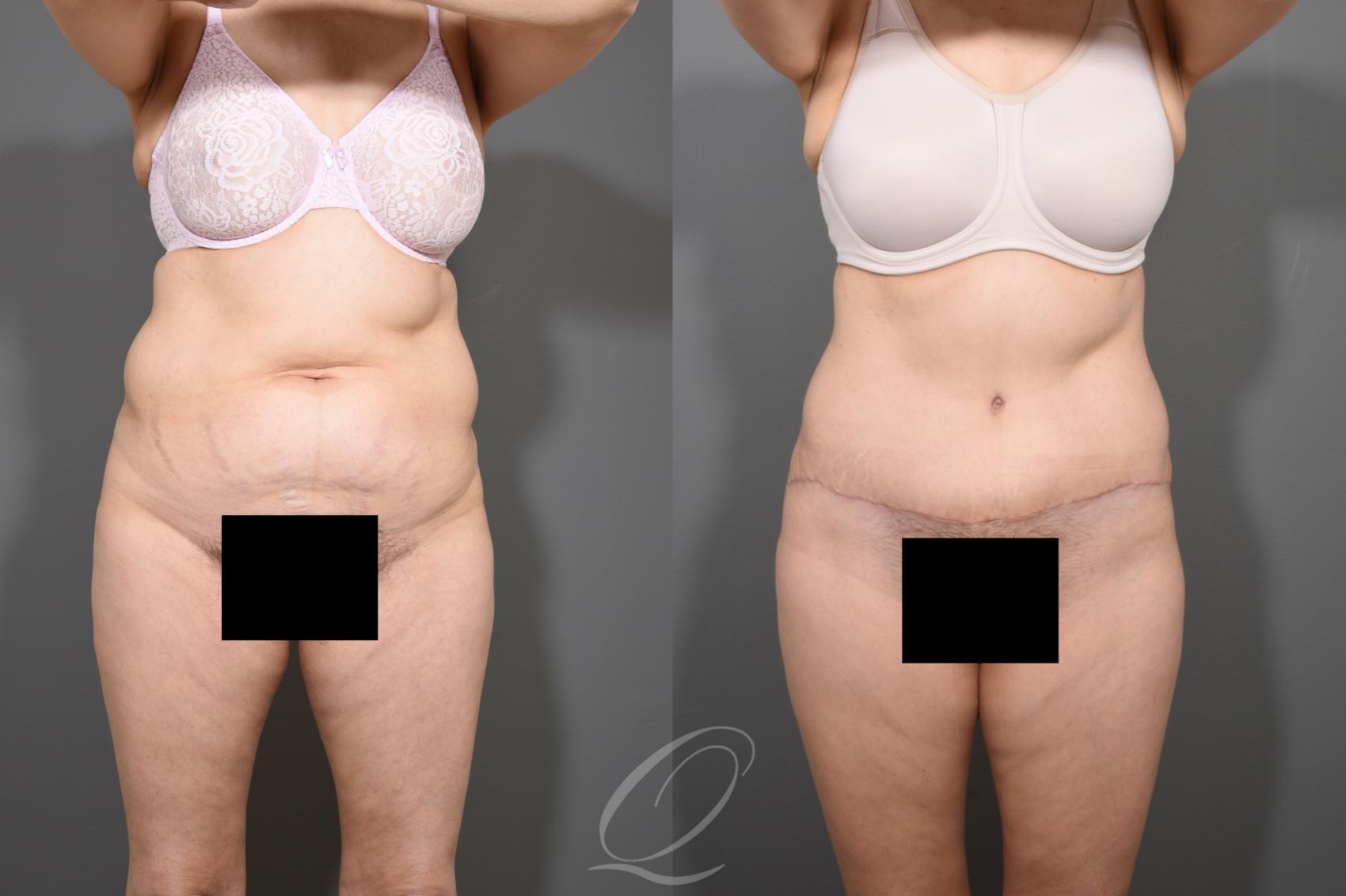 Tummy Tuck Case 372 Before & After View #1 | Serving Rochester, Syracuse & Buffalo, NY | Quatela Center for Plastic Surgery