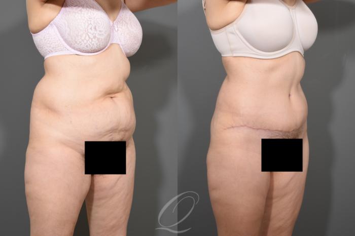 Tummy Tuck Case 372 Before & After View #2 | Serving Rochester, Syracuse & Buffalo, NY | Quatela Center for Plastic Surgery