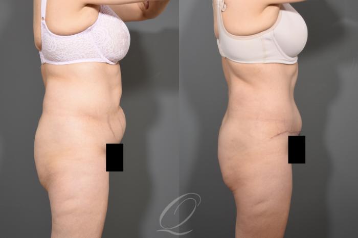 Tummy Tuck Case 372 Before & After View #3 | Serving Rochester, Syracuse & Buffalo, NY | Quatela Center for Plastic Surgery