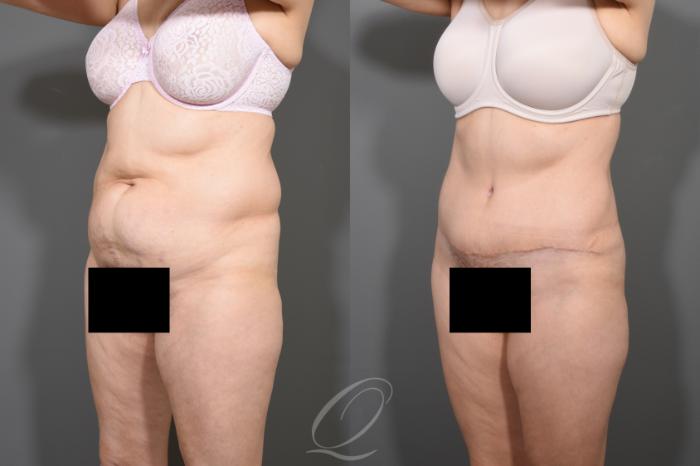 Tummy Tuck Case 372 Before & After View #4 | Serving Rochester, Syracuse & Buffalo, NY | Quatela Center for Plastic Surgery
