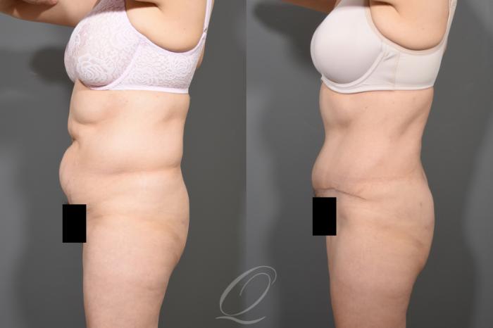 Tummy Tuck Case 372 Before & After View #5 | Serving Rochester, Syracuse & Buffalo, NY | Quatela Center for Plastic Surgery