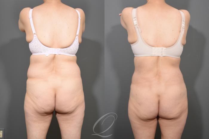 Tummy Tuck Case 372 Before & After View #6 | Serving Rochester, Syracuse & Buffalo, NY | Quatela Center for Plastic Surgery