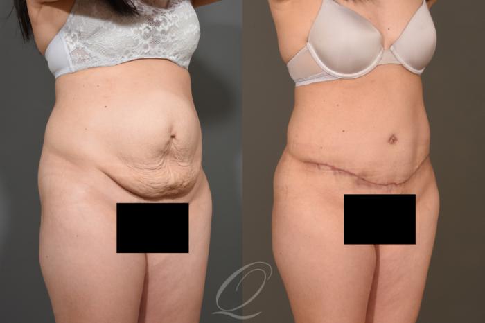 Tummy Tuck Case 373 Before & After View #2 | Serving Rochester, Syracuse & Buffalo, NY | Quatela Center for Plastic Surgery