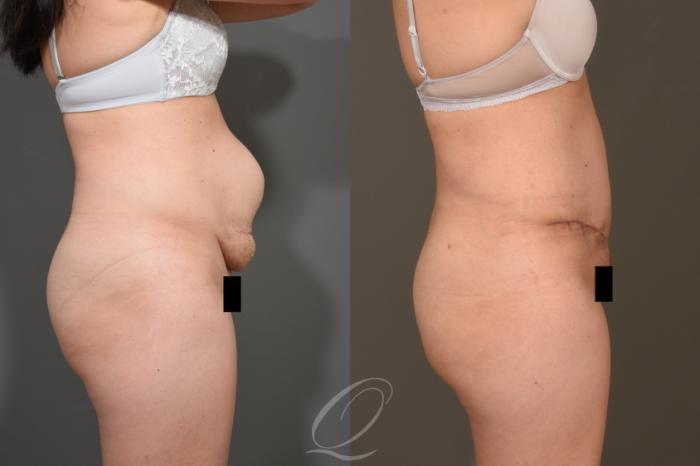 Tummy Tuck Case 373 Before & After View #3 | Serving Rochester, Syracuse & Buffalo, NY | Quatela Center for Plastic Surgery