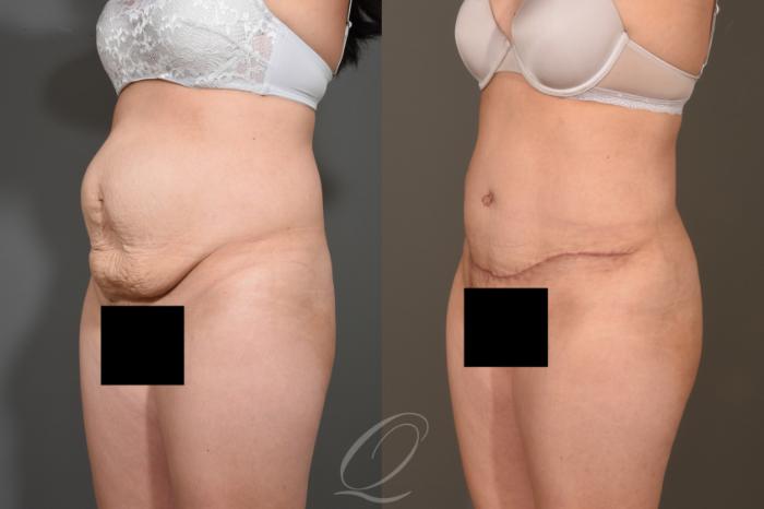 Tummy Tuck Case 373 Before & After View #4 | Serving Rochester, Syracuse & Buffalo, NY | Quatela Center for Plastic Surgery
