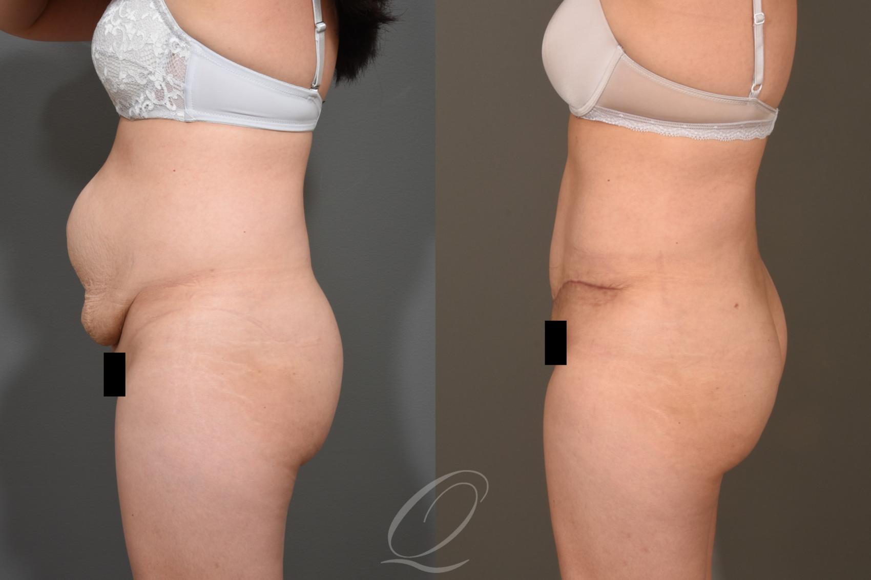 Tummy Tuck Case 373 Before & After View #5 | Serving Rochester, Syracuse & Buffalo, NY | Quatela Center for Plastic Surgery