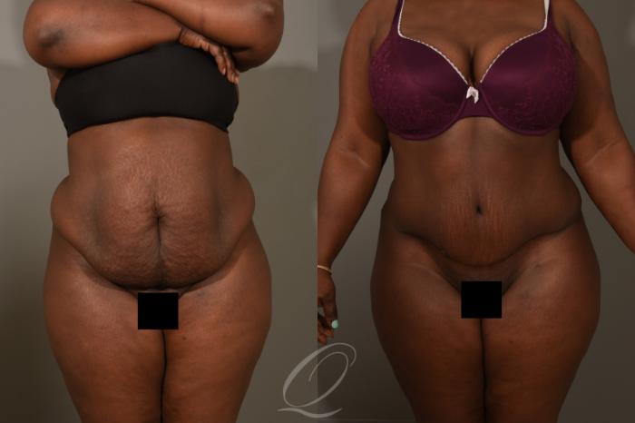 Tummy Tuck Case 376 Before & After View #1 | Serving Rochester, Syracuse & Buffalo, NY | Quatela Center for Plastic Surgery