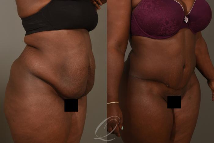 Tummy Tuck Case 376 Before & After View #2 | Serving Rochester, Syracuse & Buffalo, NY | Quatela Center for Plastic Surgery