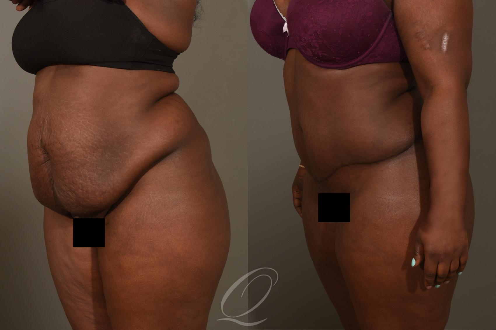 Tummy Tuck Case 376 Before & After View #3 | Serving Rochester, Syracuse & Buffalo, NY | Quatela Center for Plastic Surgery