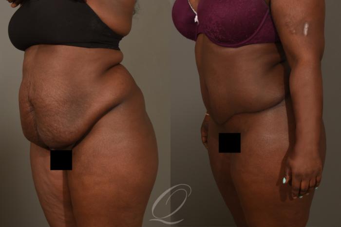 Tummy Tuck Case 376 Before & After View #3 | Serving Rochester, Syracuse & Buffalo, NY | Quatela Center for Plastic Surgery