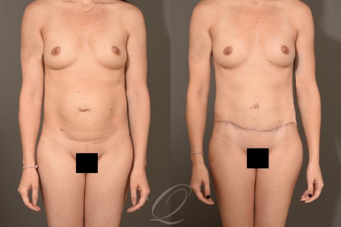 Tummy Tuck Case 377 Before & After View #1 | Serving Rochester, Syracuse & Buffalo, NY | Quatela Center for Plastic Surgery