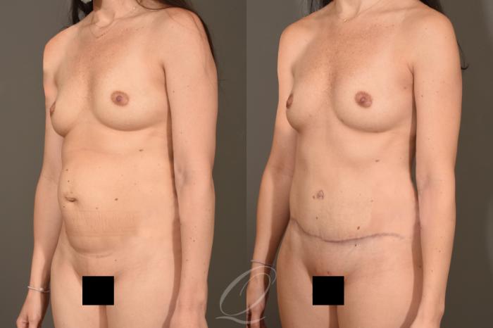 Breast Augmentation with Fat Transfer Case 377 Before & After View #4 | Serving Rochester, Syracuse & Buffalo, NY | Quatela Center for Plastic Surgery