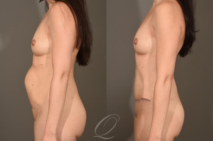 Breast Augmentation with Fat Transfer Case 377 Before & After View #5 | Serving Rochester, Syracuse & Buffalo, NY | Quatela Center for Plastic Surgery