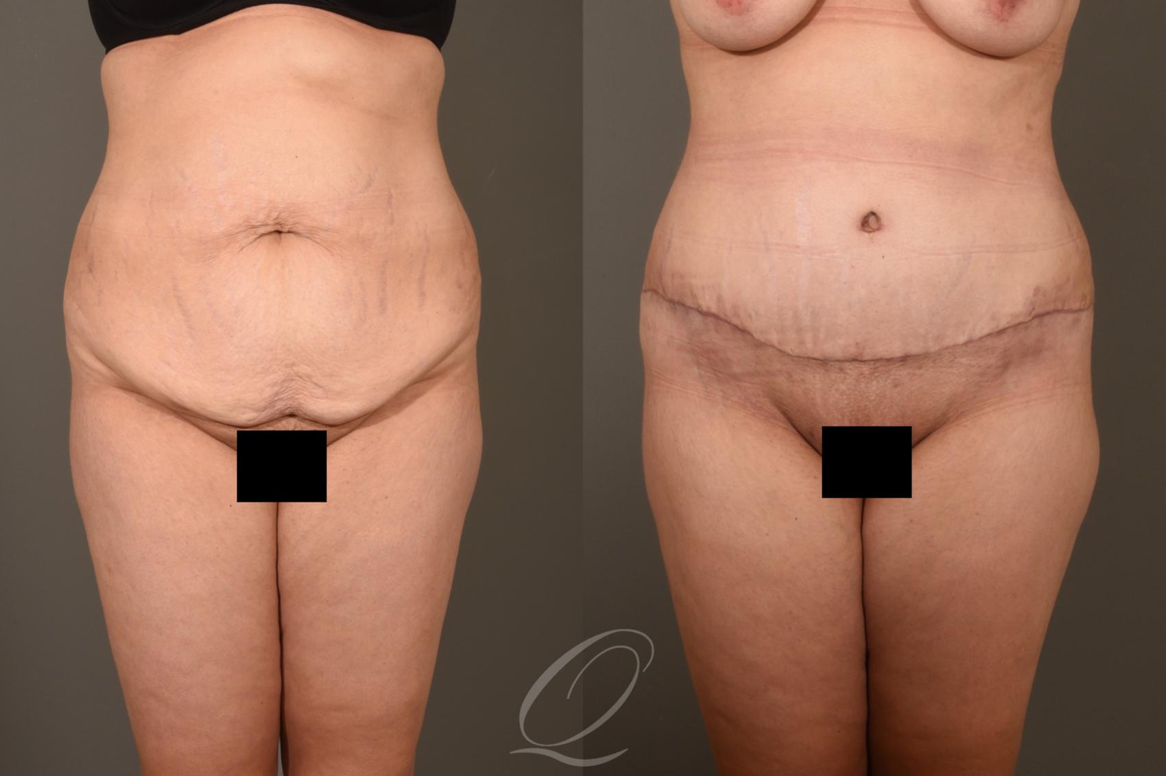 Tummy Tuck Case 378 Before & After View #1 | Serving Rochester, Syracuse & Buffalo, NY | Quatela Center for Plastic Surgery