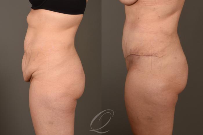 Tummy Tuck Case 378 Before & After View #2 | Serving Rochester, Syracuse & Buffalo, NY | Quatela Center for Plastic Surgery